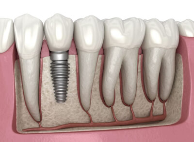 Dental-implant-illustration