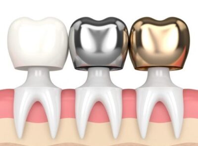 dental-crowns-2-e1622878874318