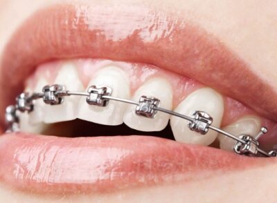 understanding-metal-braces