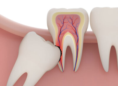 wisdom-tooth-extraction