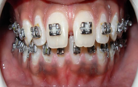 img-braces8-after